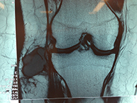 Ganglion Tib Fib Joint